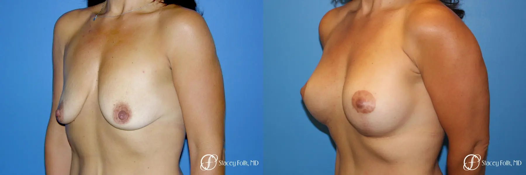 Denver Breast Augmentation Mastopexy 5366 - Before and After 2