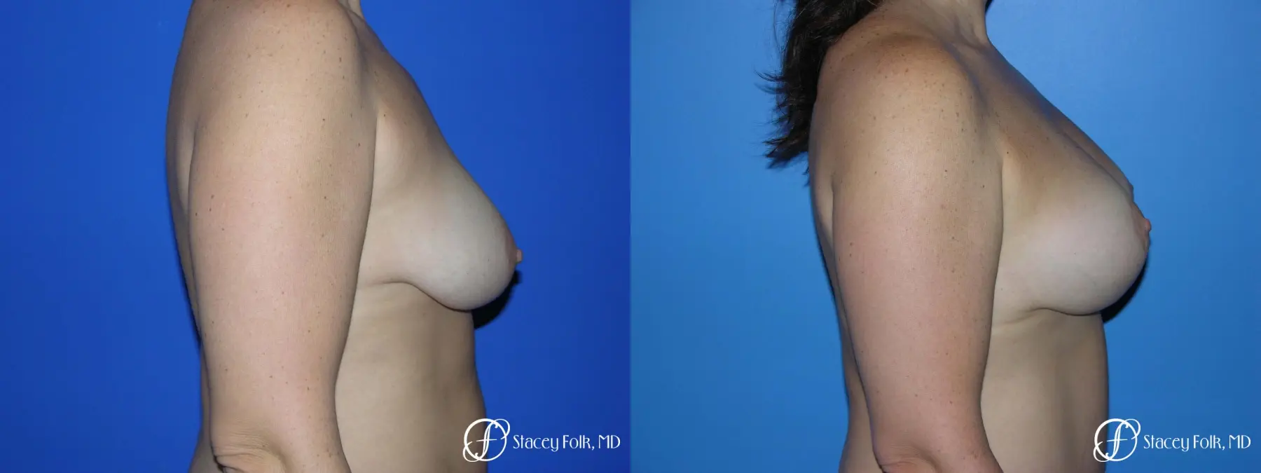 Denver Breast Lift - Mastopexy Augmentation 7989 - Before and After 3