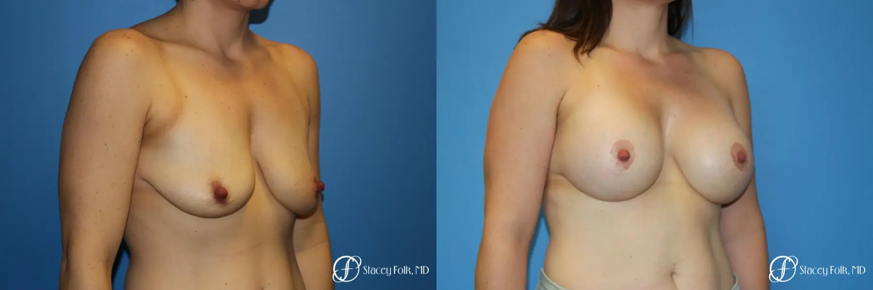 Denver Breast Lift (Mastopexy) with agumentation 9093 - Before and After 2