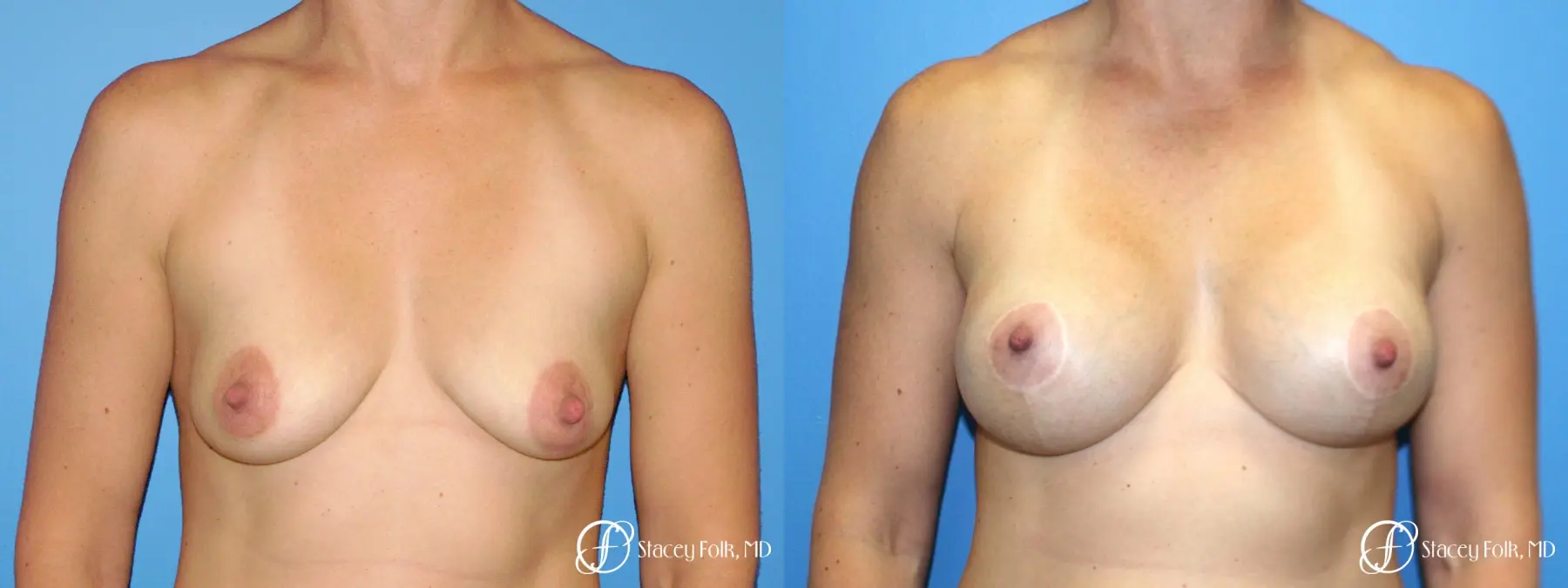 Denver Breast Augmentation with a Breast Lift - Mastopexy 8361 - Before and After 1
