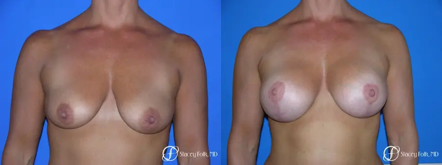 Denver Breast Lift and Augmentation 4556 - Before and After