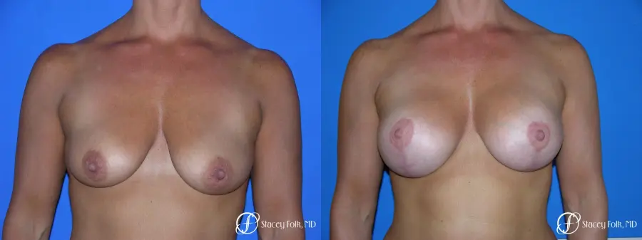 Denver Breast Lift and Augmentation 4556 - Before and After 1