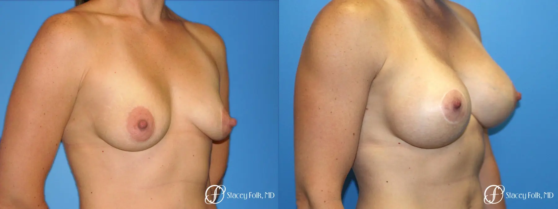 Denver Breast Augmentation with a Breast Lift - Mastopexy 8361 - Before and After 2