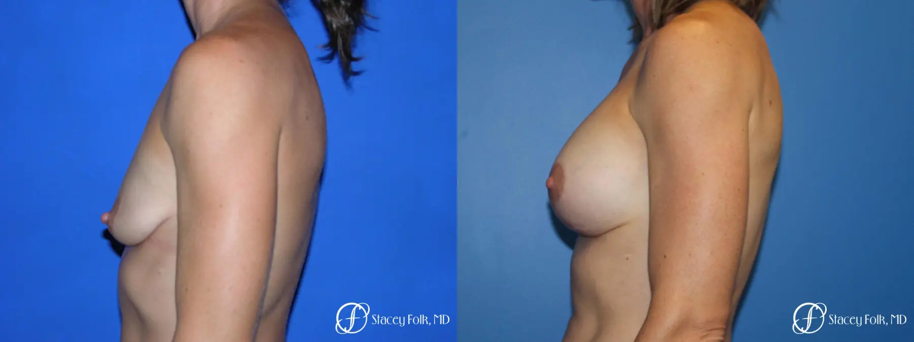 Denver Breast augmentation and breast lift (Mastopexy) 10091 - Before and After 4