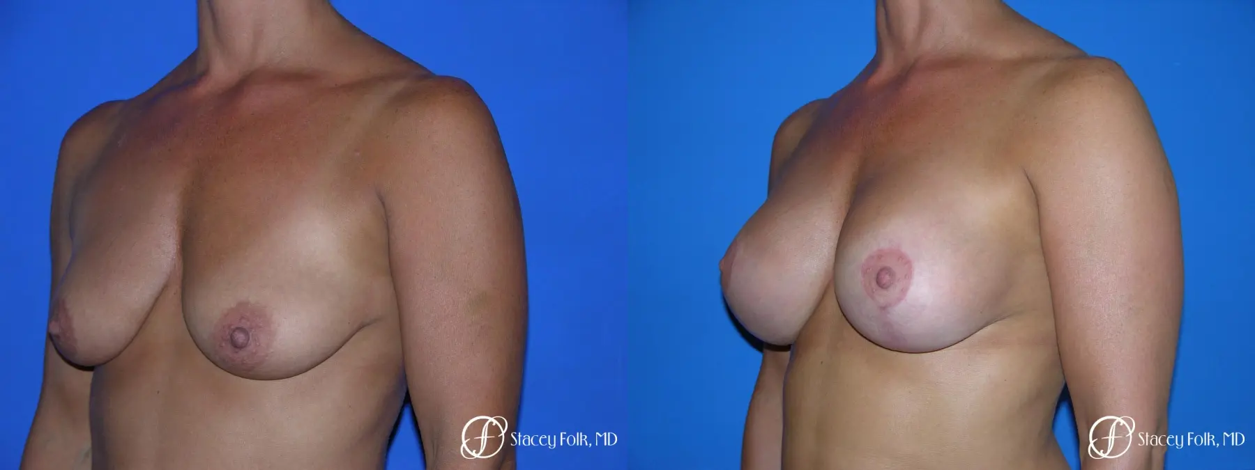 Denver Breast Lift and Augmentation 4556 - Before and After 2