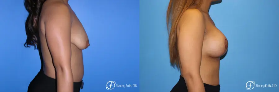 Denver Breast augmentation mastopexy 4815 - Before and After 3
