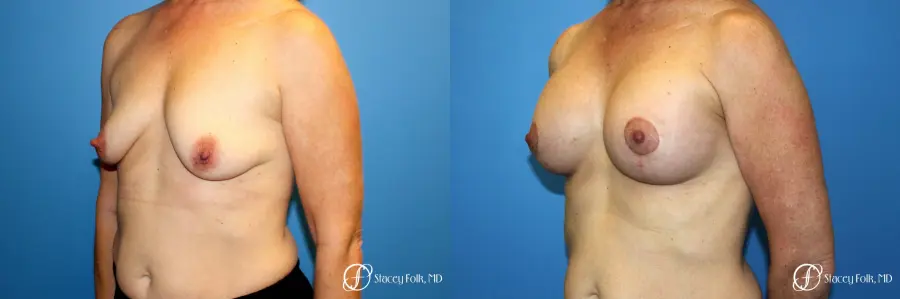 Denver Breast Augmentation Mastopexy 8163 - Before and After 2