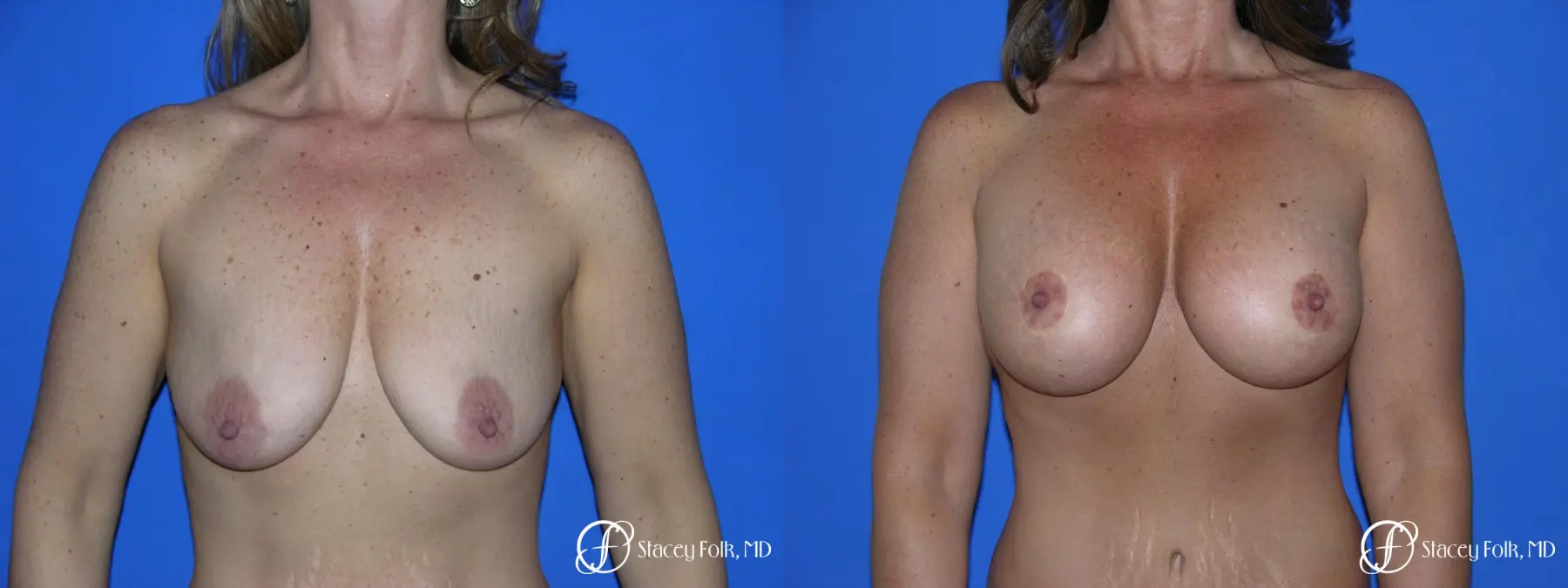 Denver Breast Lift and Augmentation 4560 - Before and After