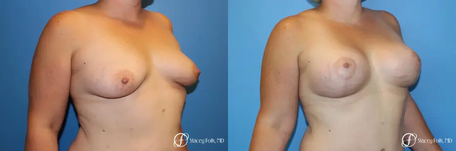 Denver Breast Augmentation Mastopexy 8507 - Before and After 3