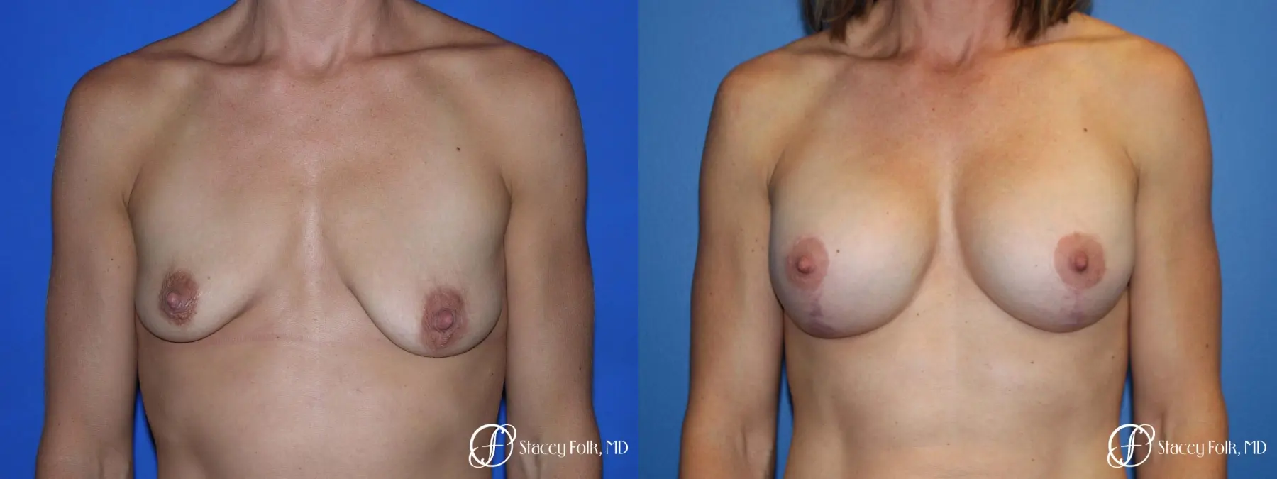 Denver Breast augmentation and breast lift (Mastopexy) 10091 - Before and After