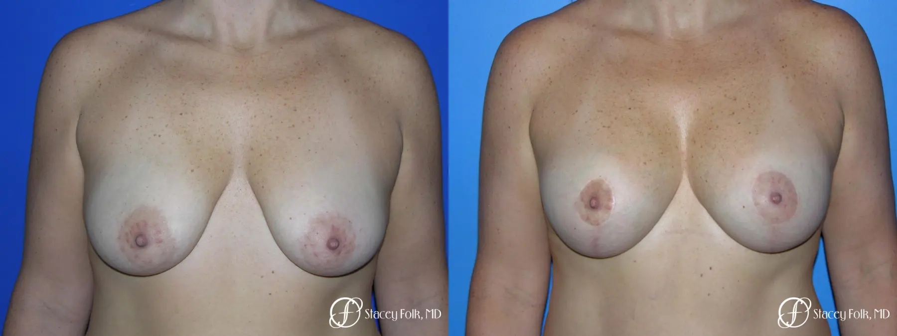 Denver Breast Lift - Mastopexy Augmentation 7989 - Before and After 1