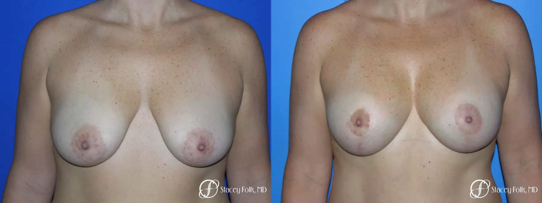 Denver Breast Lift - Mastopexy Augmentation 7989 - Before and After