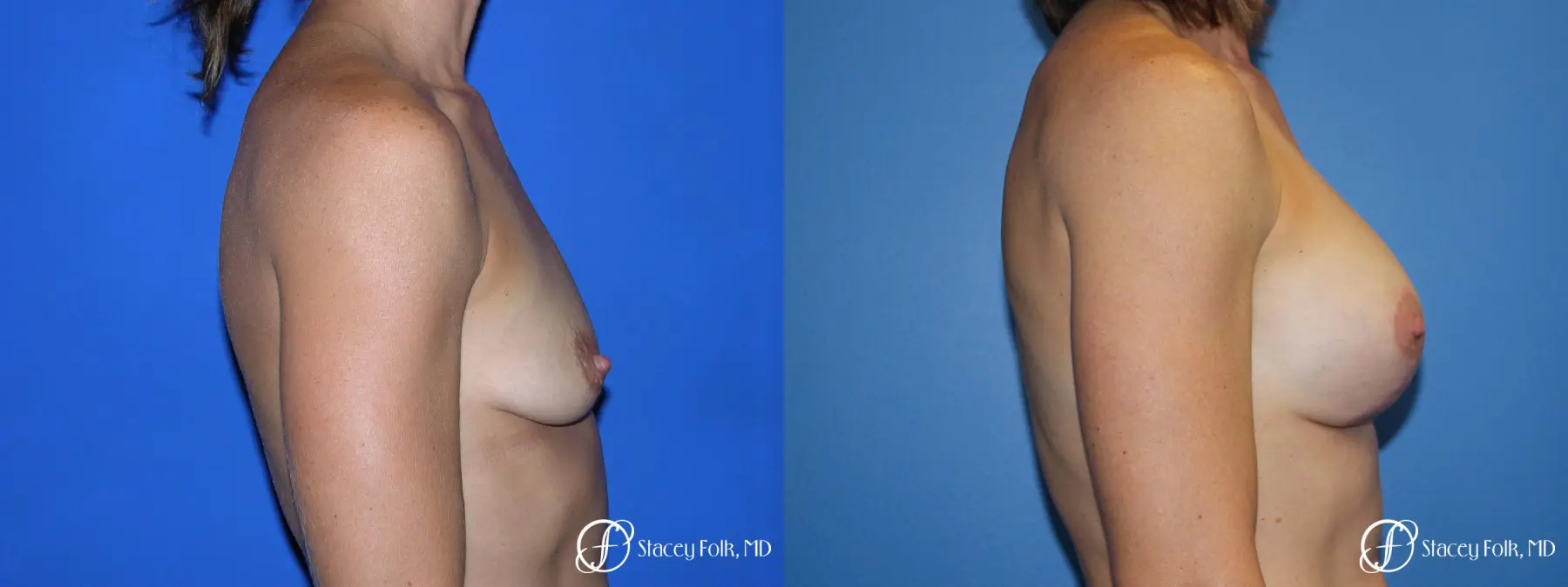 Denver Breast augmentation and breast lift (Mastopexy) 10091 - Before and After 5