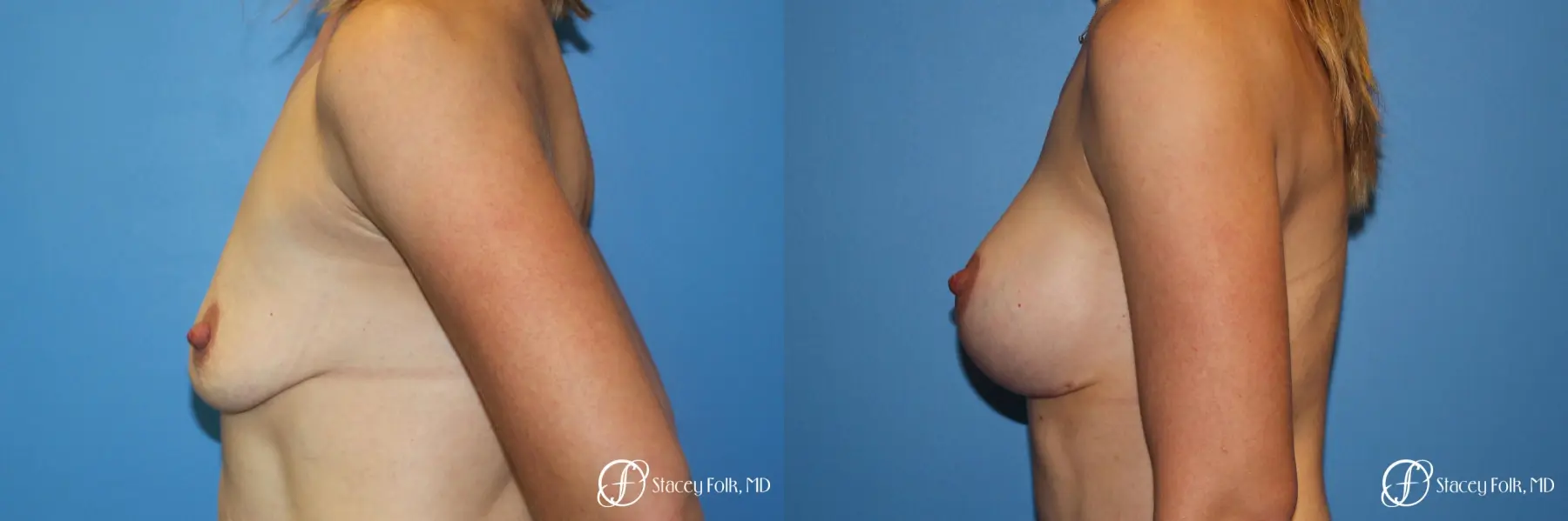 Breast Augmentation and Breast lift (Mastopexy) - Before and After 2