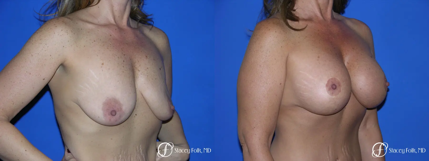 Denver Breast Lift and Augmentation 4560 - Before and After 2