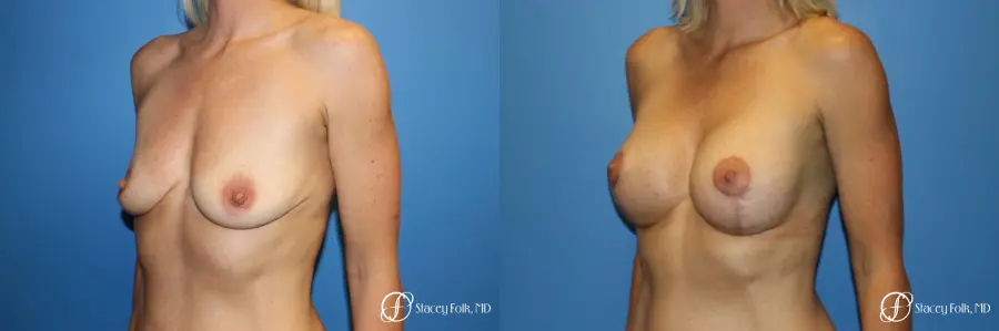Breast augmentation with breast lift (Mastopexy) - Before and After 2