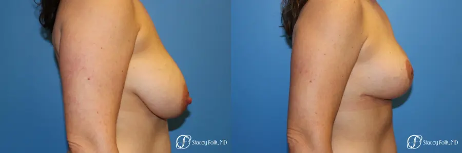 Denver Breast Lift - Mastopexy 7988 - Before and After 3