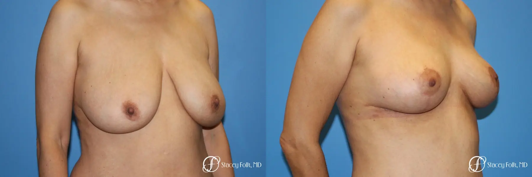 Denver Breast Lift - Mastopexy 7984 - Before and After 2