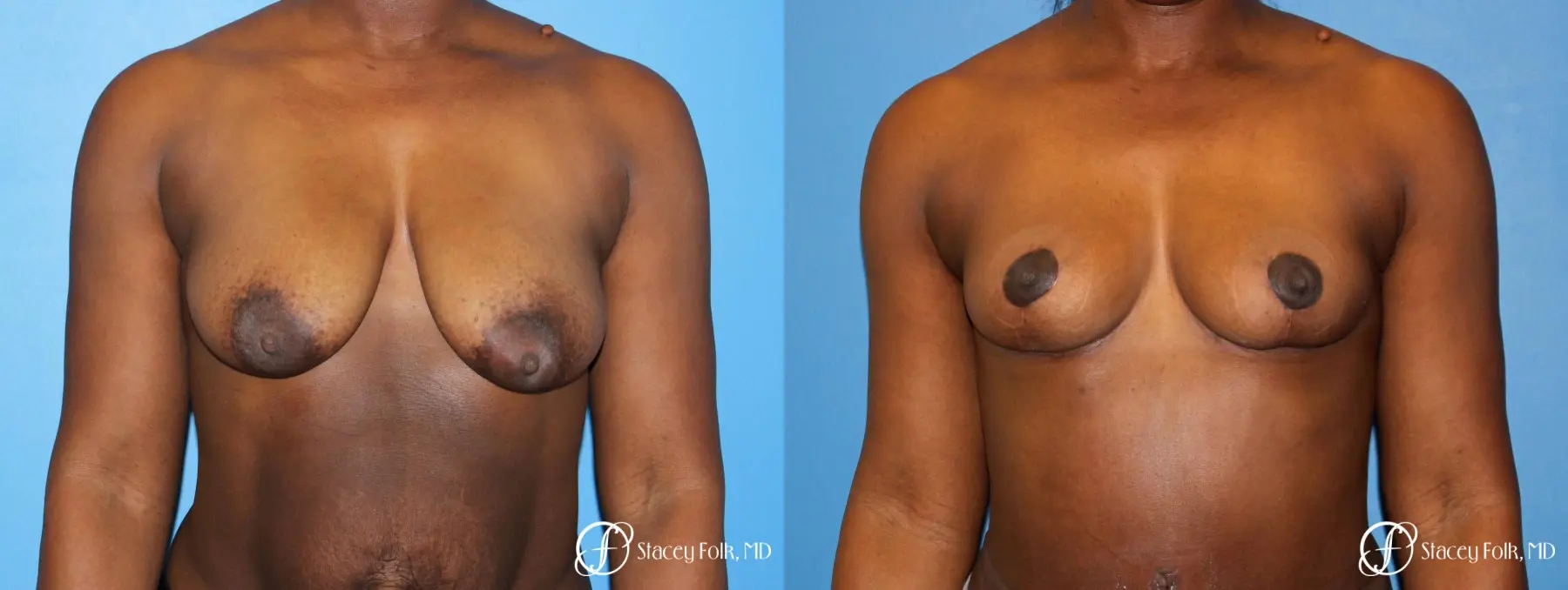Denver Breast Lift - Mastopexy 7172 - Before and After