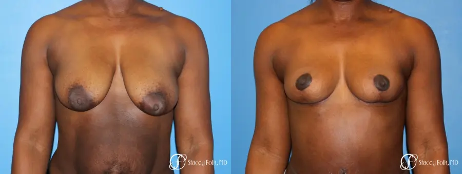 Denver Breast Lift - Mastopexy 7172 - Before and After 1