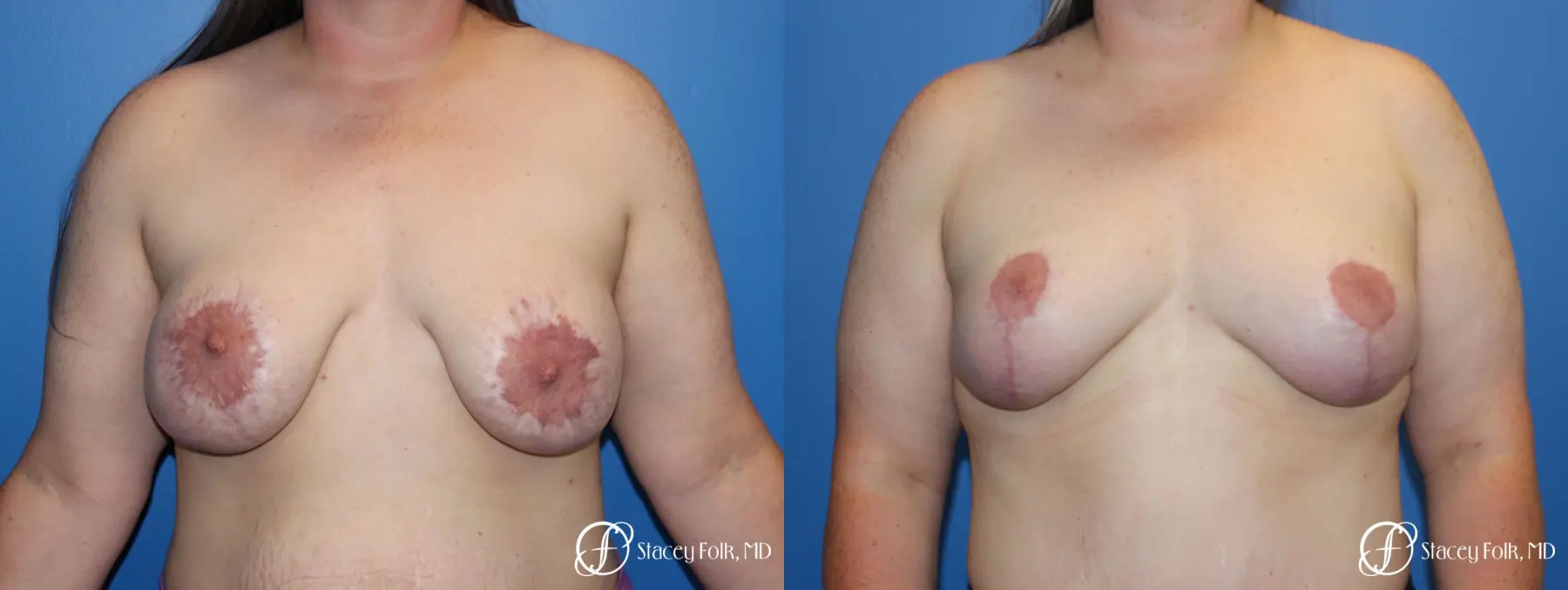 Breast Lift (Mastopexy) - Before and After 1