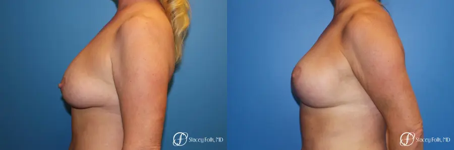 Denver Breast Lift 10252 - Before and After 2