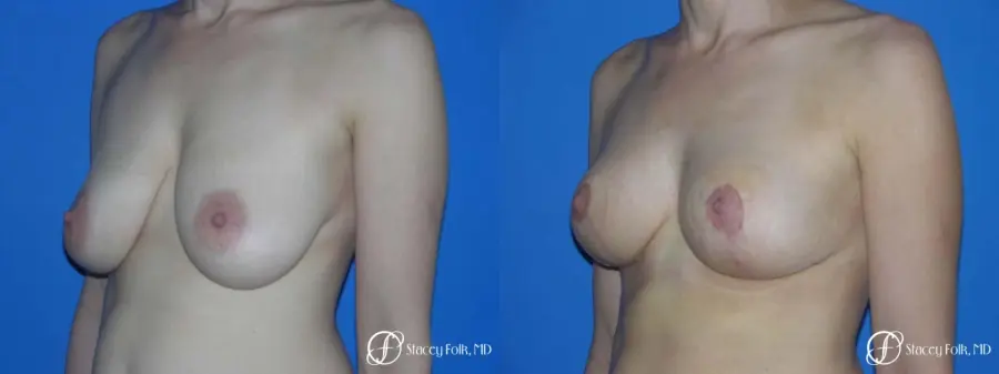 Denver Breast Lift - Mastopexy 7983 - Before and After 2
