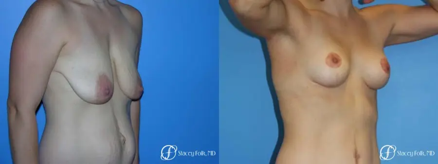Denver Breast Lift - Mastopexy 7981 - Before and After 2