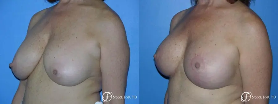 Denver Breast Lift - Mastopexy 7977 - Before and After 2