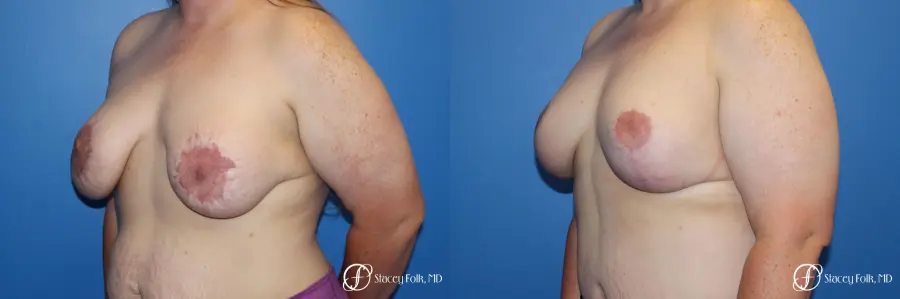 Breast Lift (Mastopexy) - Before and After 2