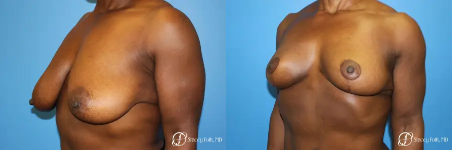 Denver Breast Lift - Mastopexy 7509 - Before and After 4
