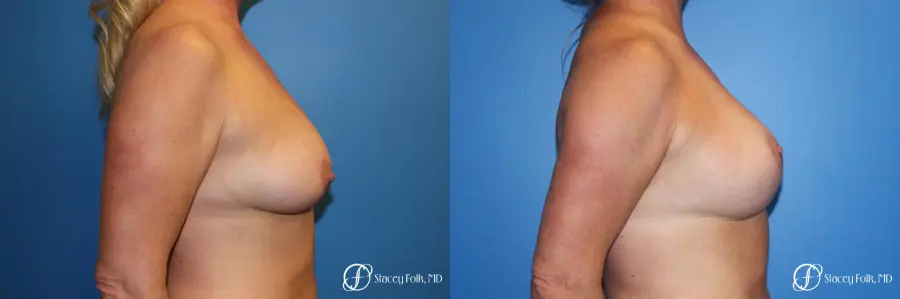 Denver Breast Lift 10252 - Before and After 3