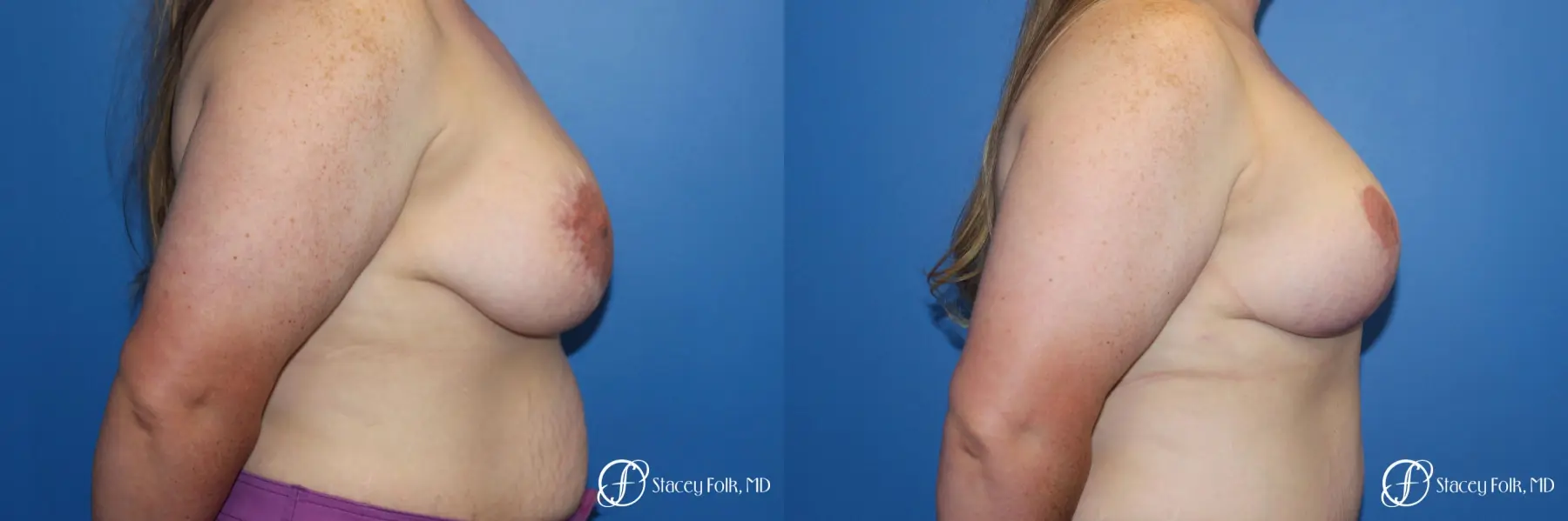 Breast Lift (Mastopexy) - Before and After 3