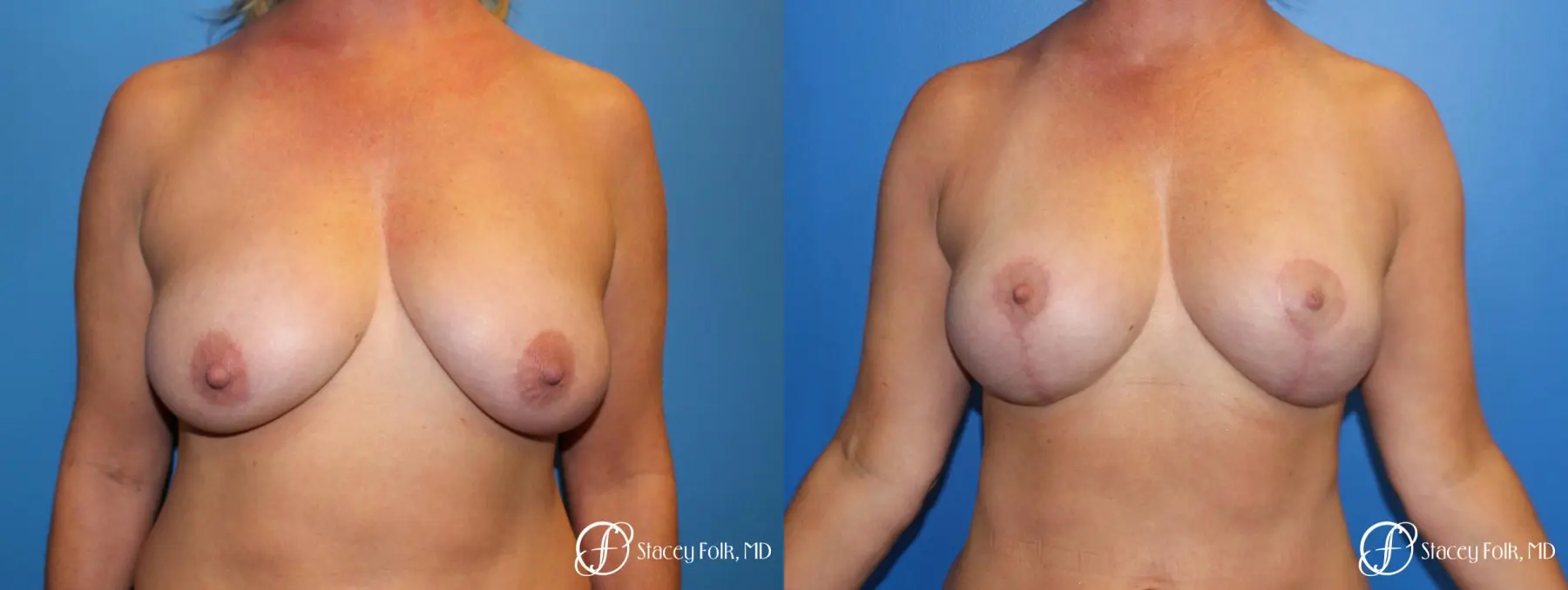 Denver Breast Lift 10252 - Before and After 1
