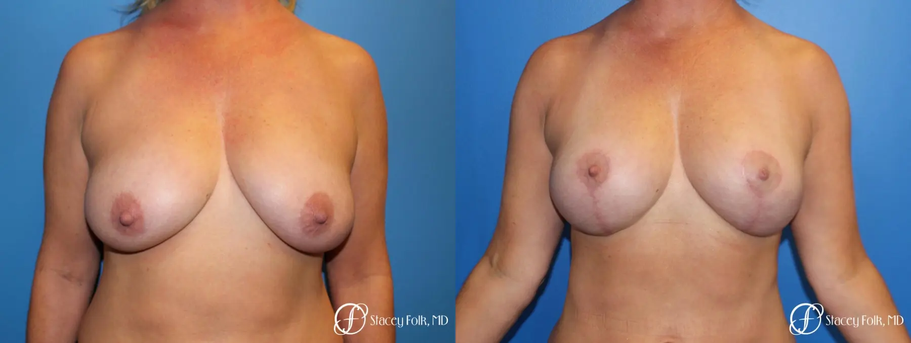 Denver Breast Lift 10252 - Before and After