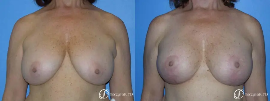 Denver Breast Lift - Mastopexy 7977 - Before and After 1