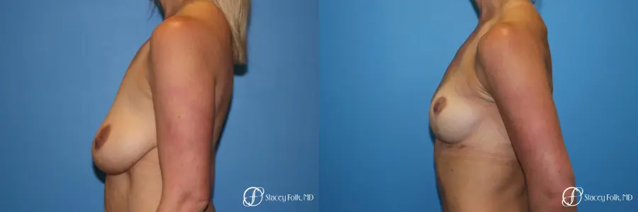 Denver Breast Lift - Mastopexy 8297 - Before and After 2