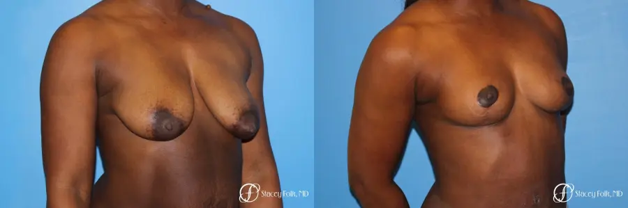 Denver Breast Lift - Mastopexy 7172 - Before and After 2