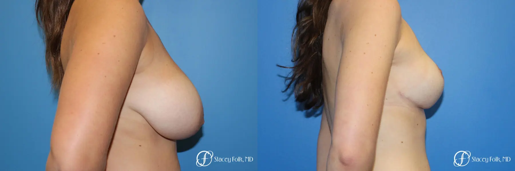 Denver Breast Lift - Mastopexy 10021 - Before and After 5