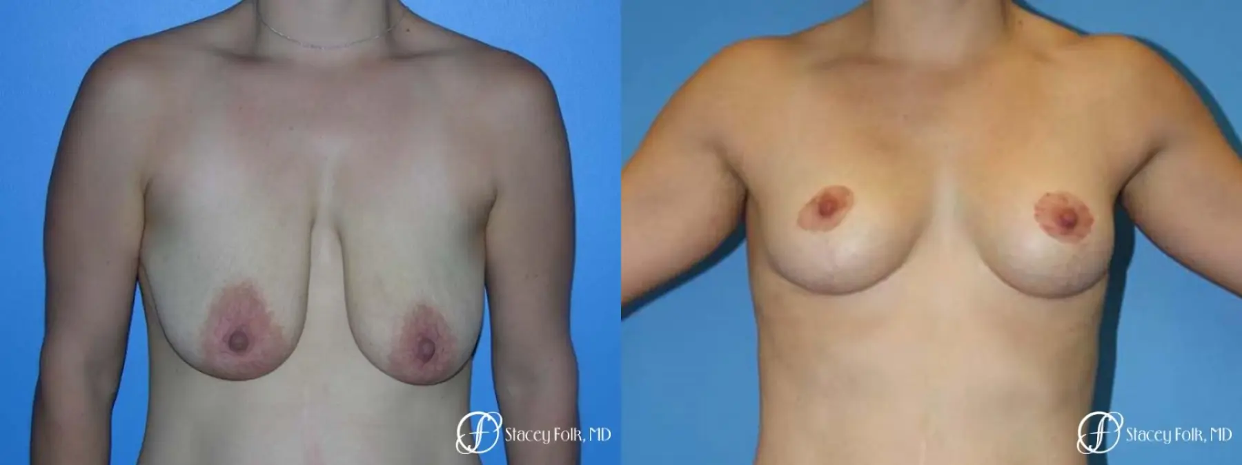 Denver Breast Lift - Mastopexy 7981 - Before and After