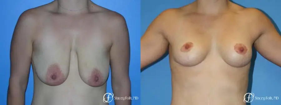 Denver Breast Lift - Mastopexy 7981 - Before and After 1