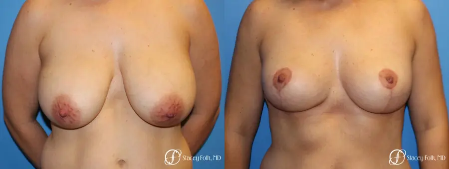 Denver Breast Lift - Mastopexy 7988 - Before and After 1
