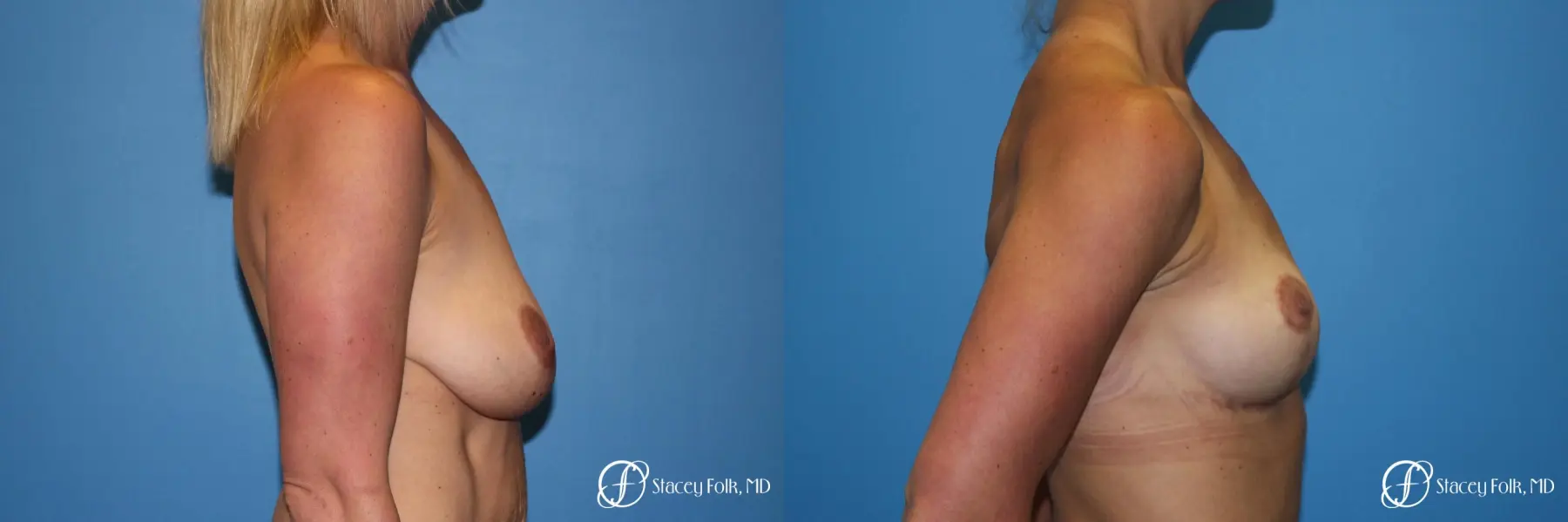Denver Breast Lift - Mastopexy 8297 - Before and After 3