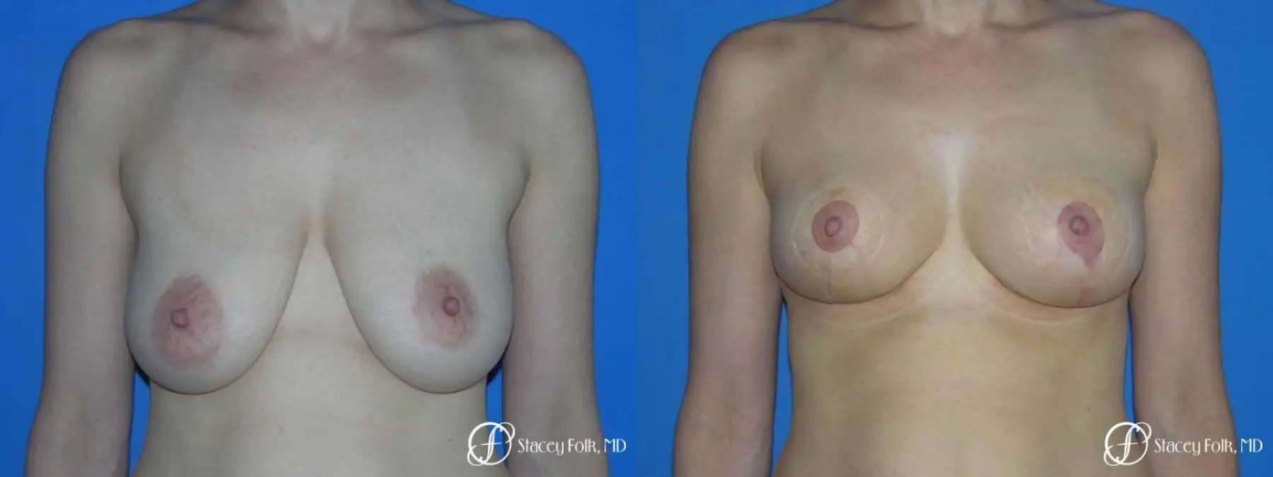 Denver Breast Lift - Mastopexy 7983 - Before and After