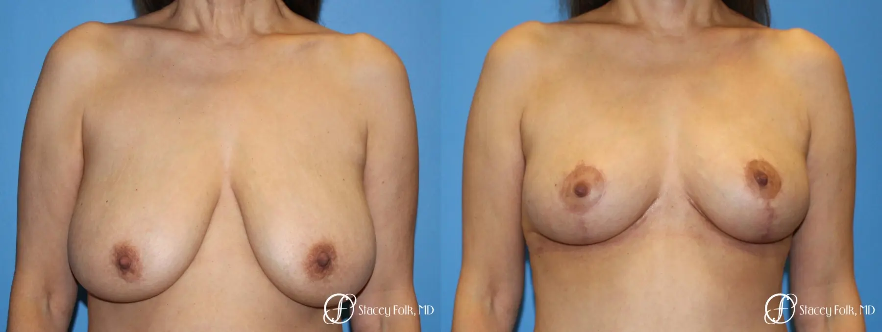 Denver Breast Lift - Mastopexy 7984 - Before and After 1