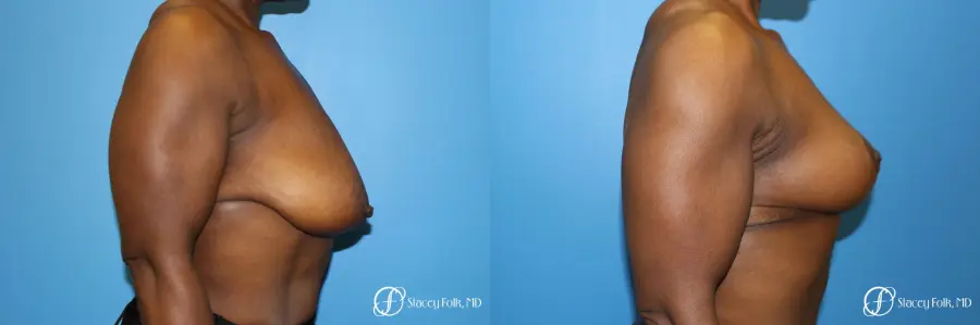 Denver Breast Lift - Mastopexy 7509 - Before and After 3