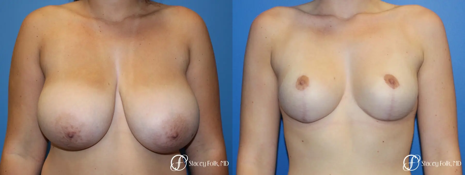 Denver Breast Lift - Mastopexy 10021 - Before and After 1