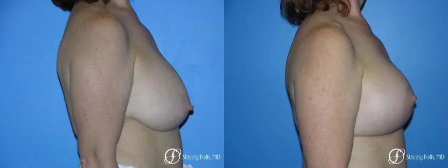 Denver Breast Lift - Mastopexy 7977 - Before and After 3
