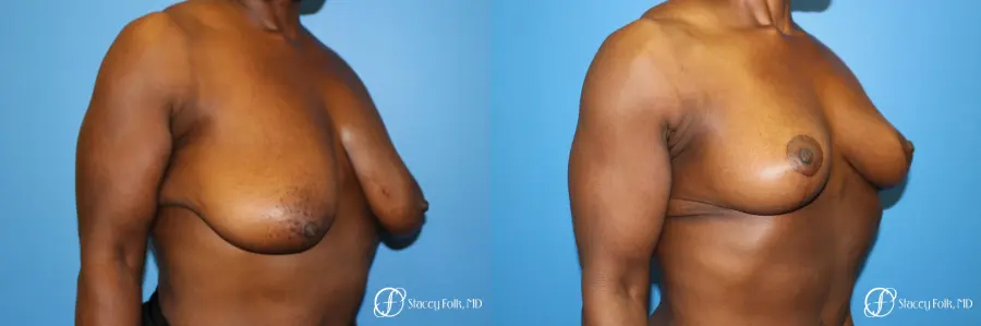 Denver Breast Lift - Mastopexy 7509 - Before and After 2