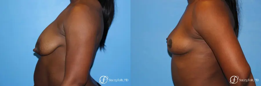 Denver Breast Lift - Mastopexy 7172 - Before and After 3